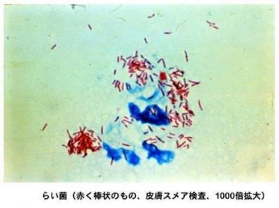 bakterie Mycobatecterium leprae.